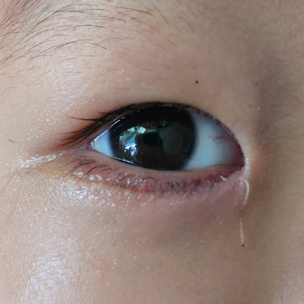수술 3일 후 눈