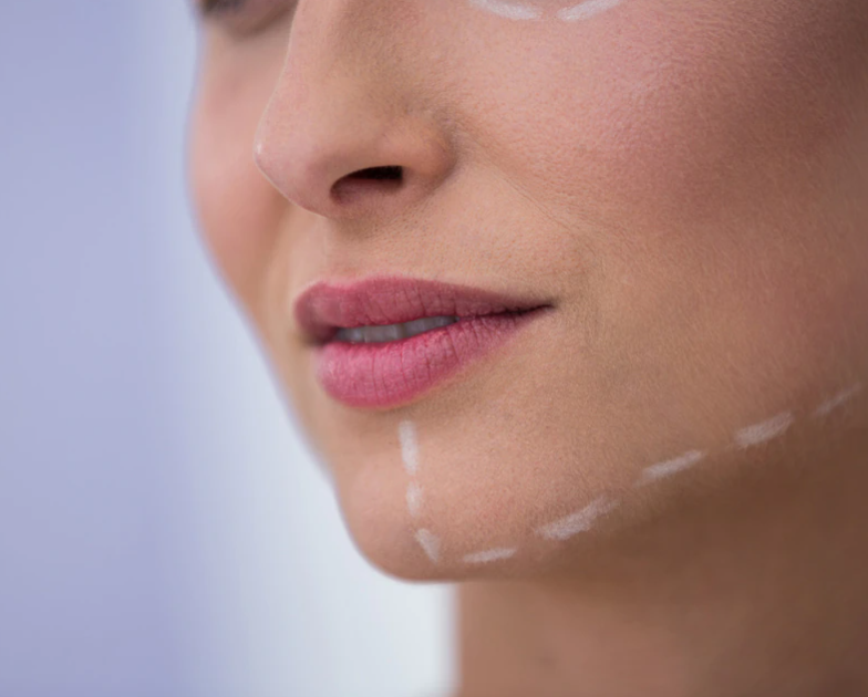 턱 수술을 위해 얼굴에 표시해둔 여성