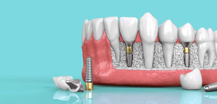오스템 임플란트 치아