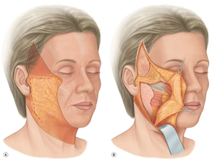 안면거상리프팅