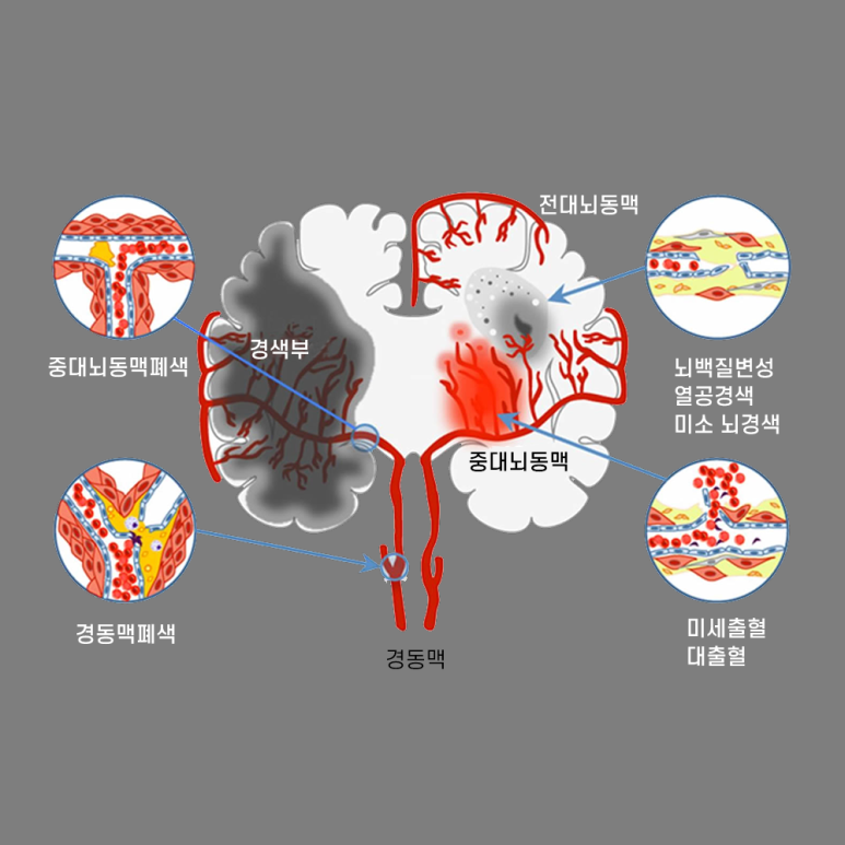 뇌동맥류 증상