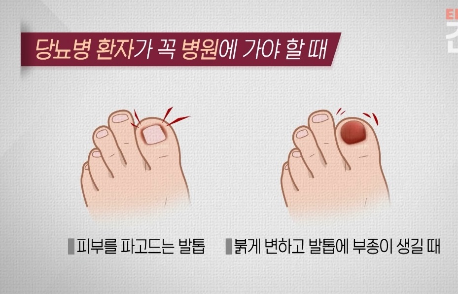 당뇨발-천동일-교수-당뇨병증상