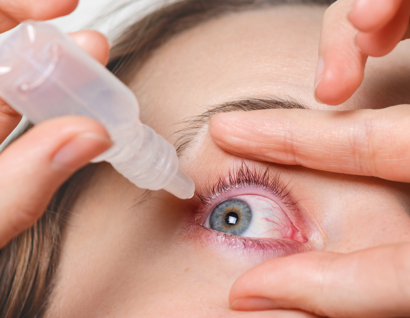 충혈된 눈에 안약을 넣고 있는 사진