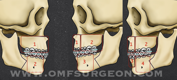 수술 전후의 사진을 비교 1