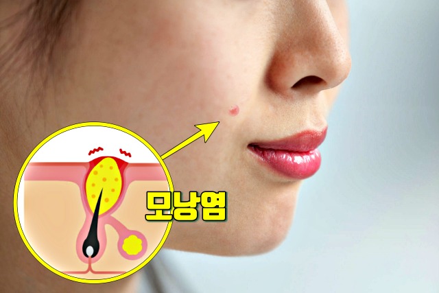 면역력이 떨어졌을때 증상 모낭염 면역력 저하 증상, 건강 팁줌 매일꿀정보