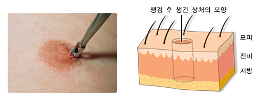 식도암