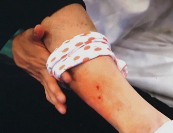 뱀에-물렸을때-응급처치