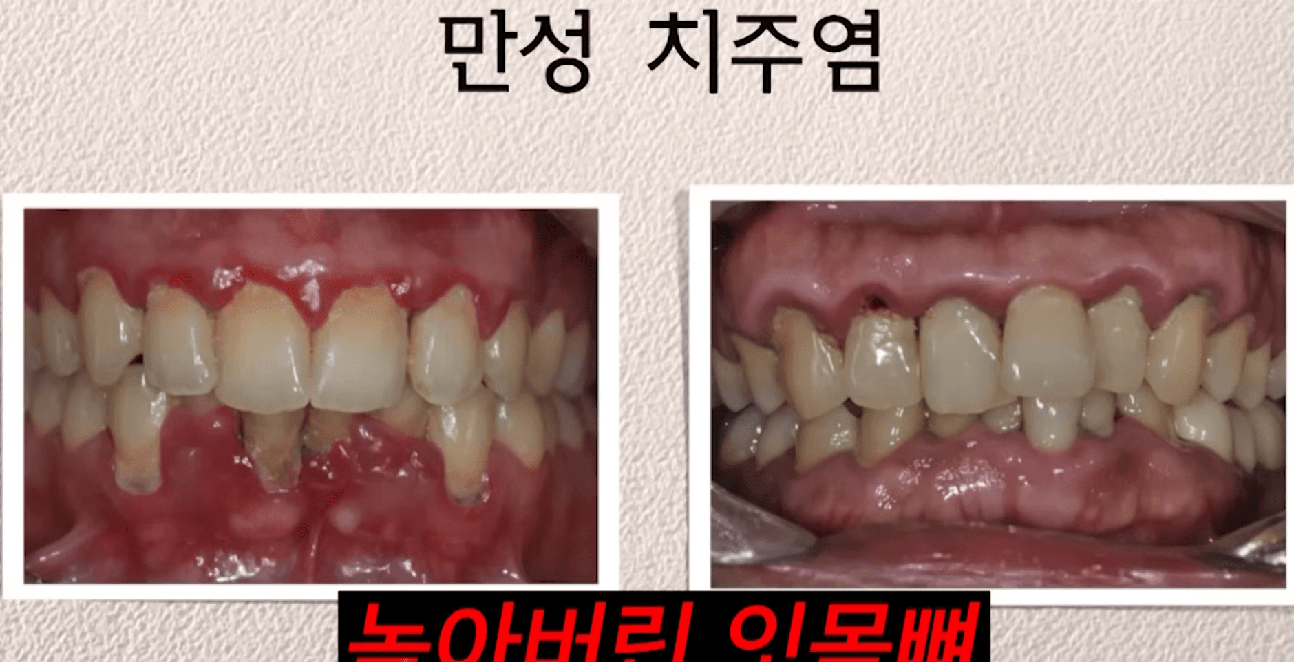 만성치주염, 녹아버린 잇몸뼈