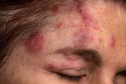 대상포진 증상, 전염, 치료방법 총정리 (2024ver)