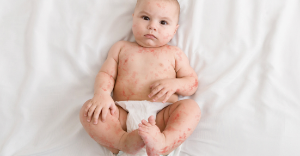 수두·대상포진