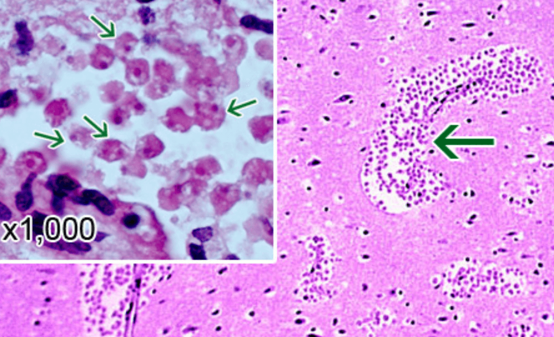 미국 뇌 먹는 아메바 네글레리아 파울러리