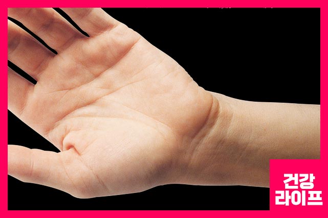 수근관이 좁아지면서 압력이 생기면 신경이 손상되면서 손목 부위에 이상 증상