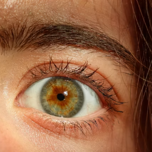 황반변성 치료법 자가진단 방법 합병증