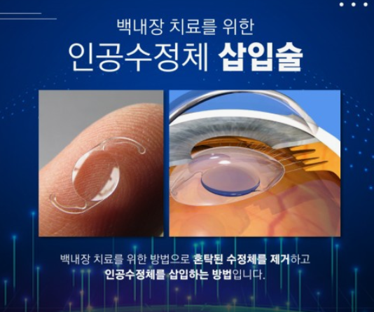 백내장의 증상과 수술 받은 후기와 비용 그리고 관리법과 주의사항