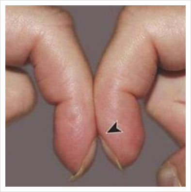 폐암 초기 증상: 손가락 변화