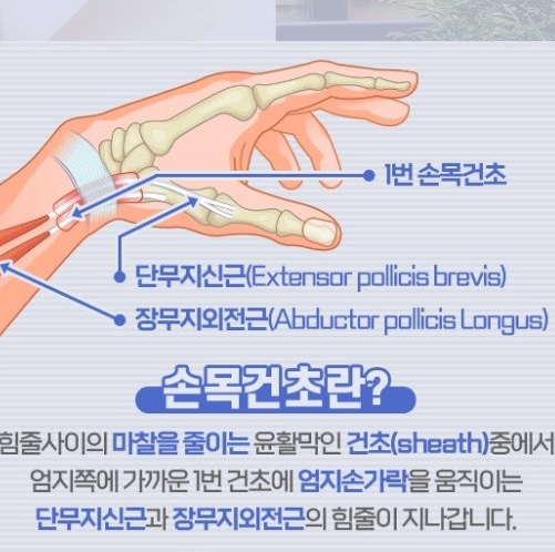 손목건초염 증가와 날씨 영향 분석 관련 이미지