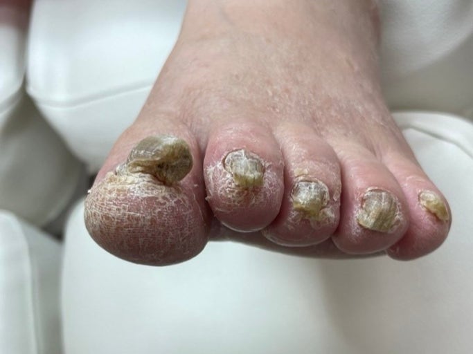 발톱 무좀의 모습