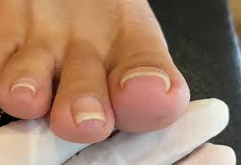 내성발톱 자가치료