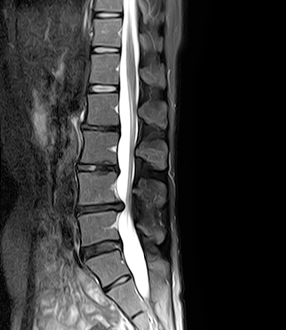 2021년 찍은 나의 허리 MRI - 모든 디스크가 까맣고 간격이 좁다.