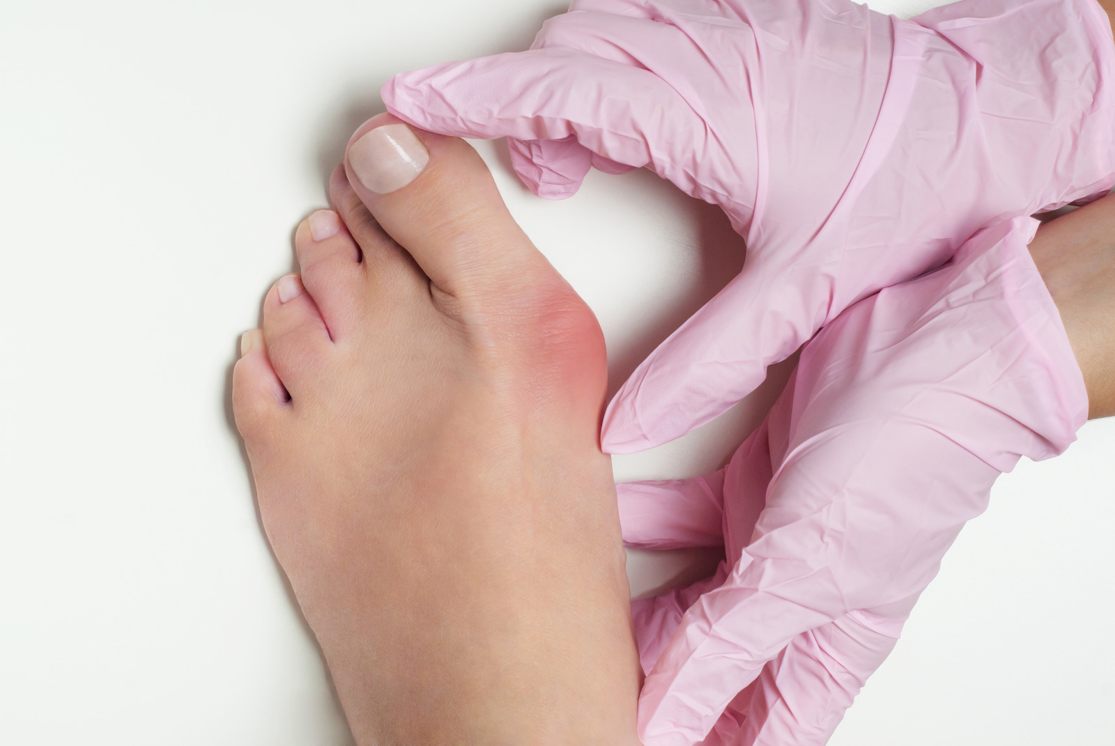 무지외반증 (Hallux Valgus) &ndash; 원인, 증상 및 치료 방법