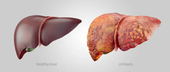 간암 말기 증상