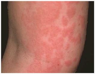 콜린성 두드러기 모습