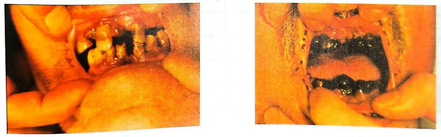 괴혈병환자의 잇몸