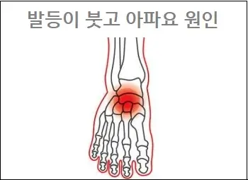 발등이 붓고 아파요 원인