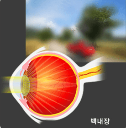 백내장 초기 증상