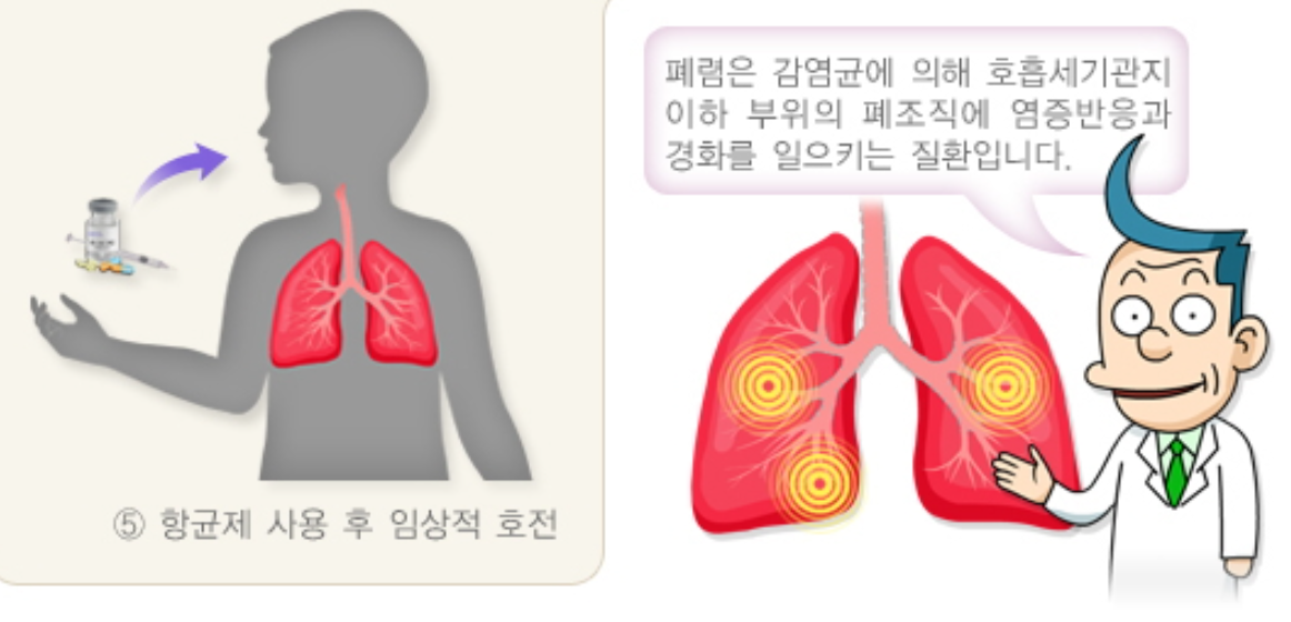 어린이 폐렴 진단 방법 3