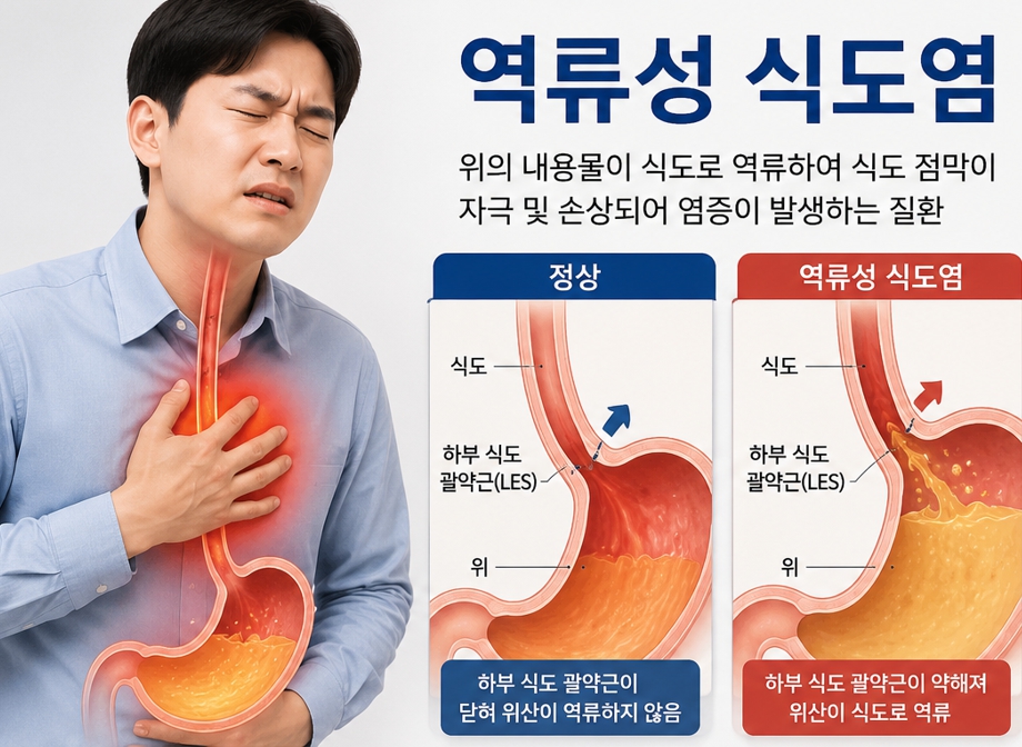 역류성 식도염