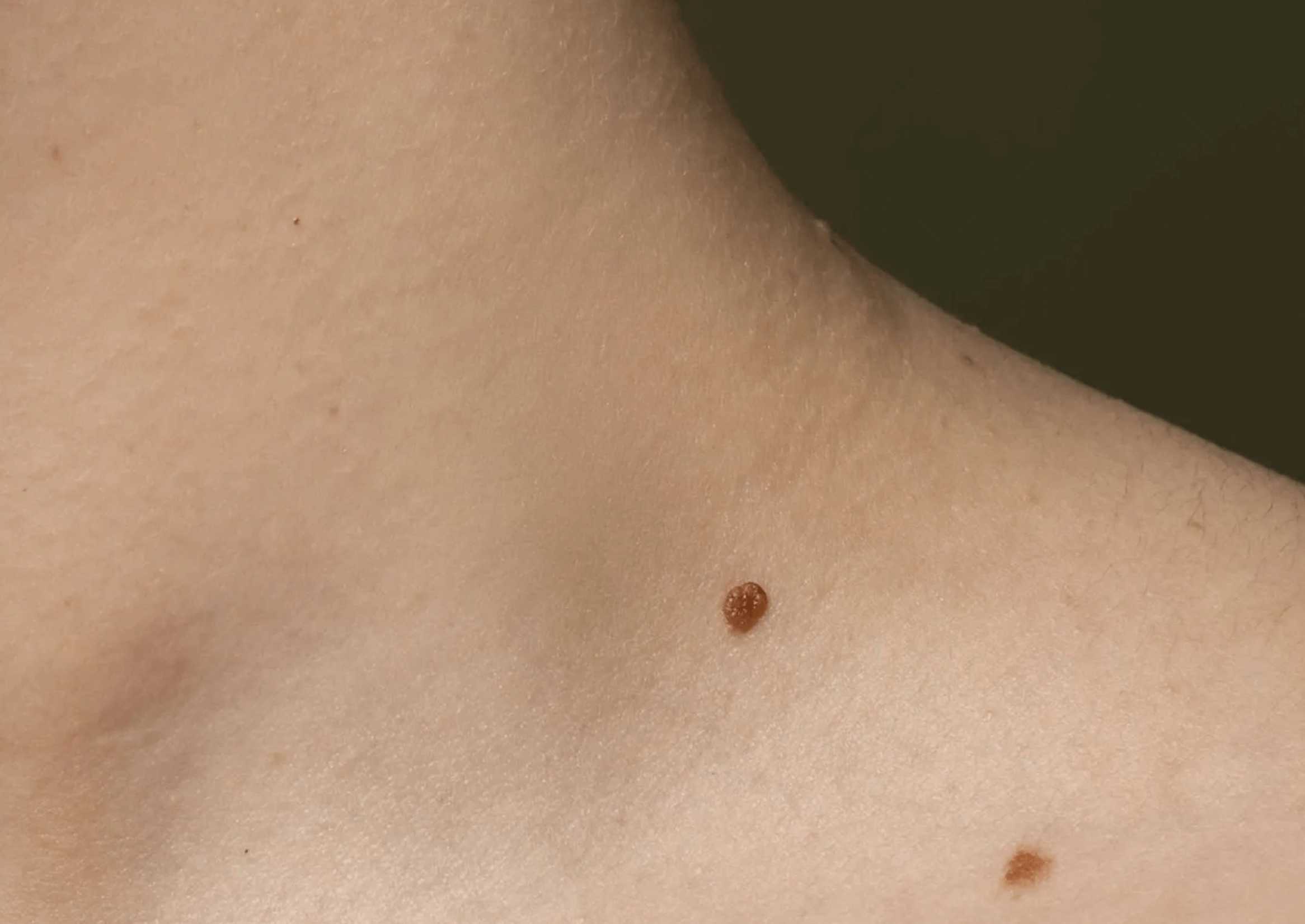 쥐젖 제거 후기