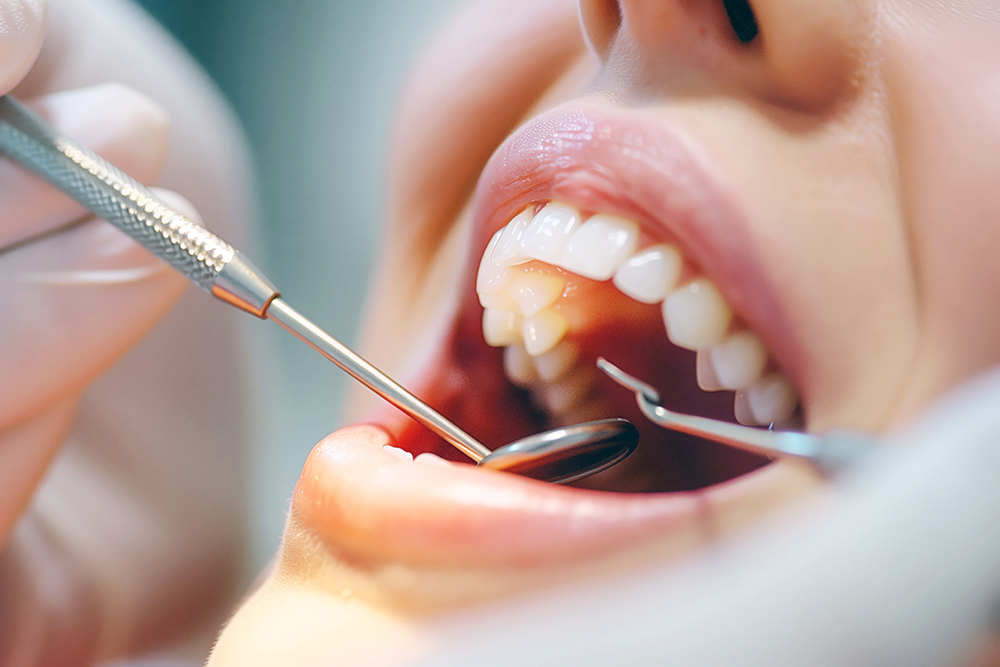 무삭제 라미네이트 가격