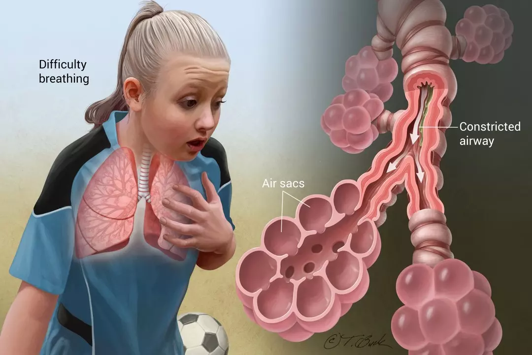 기관지 천식(Bronchial Asthma)