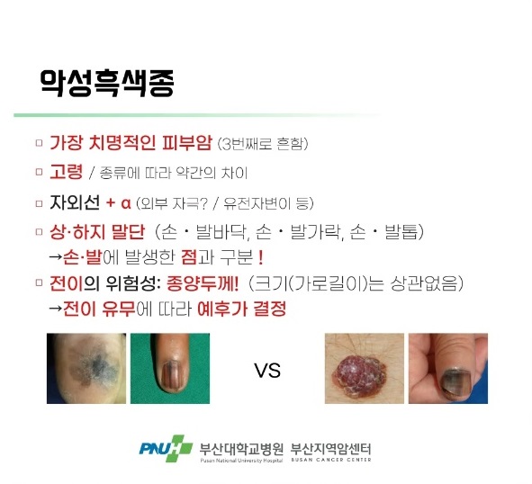 악성흑색종
