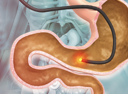 십이지장 궤양 증상 26