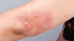 대상포진 증상 