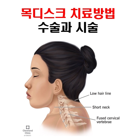 목디스크 수술과 시술 치료방법 : 언제해야할까