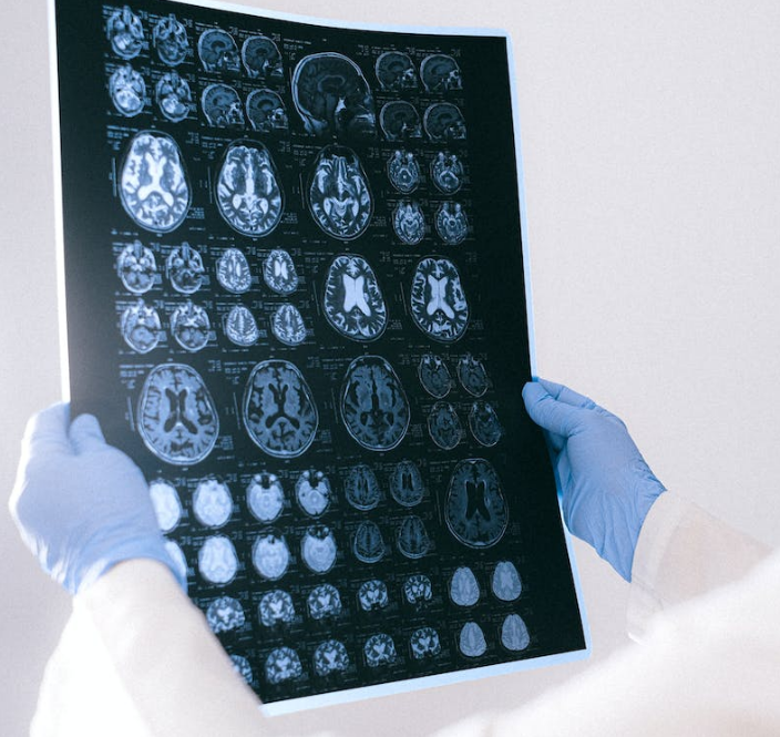 뇌동맥류는 뇌 혈관의 특별한 상태로, 혈관 벽이 약해져 풍선처럼 부풀어 오르는 상태를 나타낸다