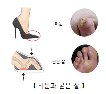 티눈과 굳은살의 원인과 증상 및 치료