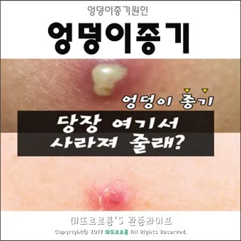 엉덩이 종기가 생기는 이유 왜 생기고 어떻게 관리할까요 완벽 가이드_14