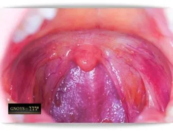 침 삼킬때 목아픔 코로나 증상인지 감별법_10