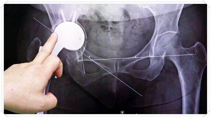 명의-엑스레이-고관절-위치
