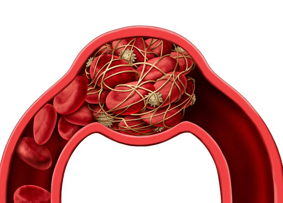 혈전 없애는 방법