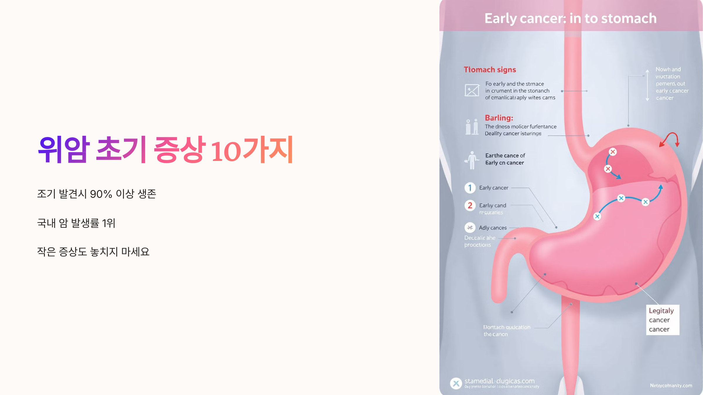 위암 초기 증상 10가지