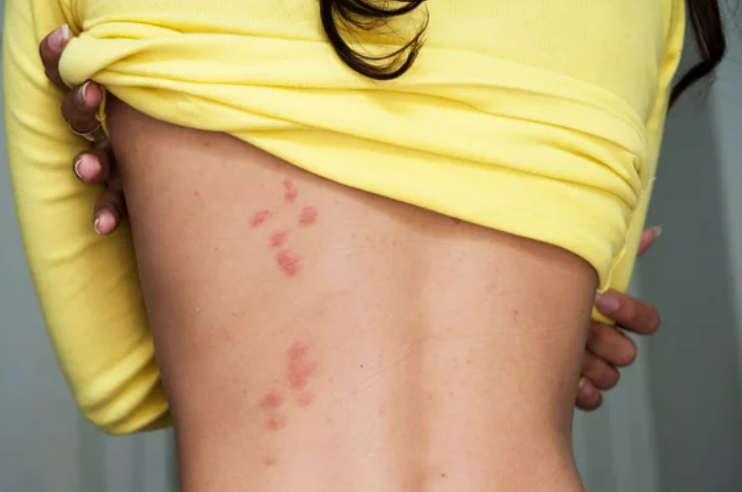 빈대 물린 자국