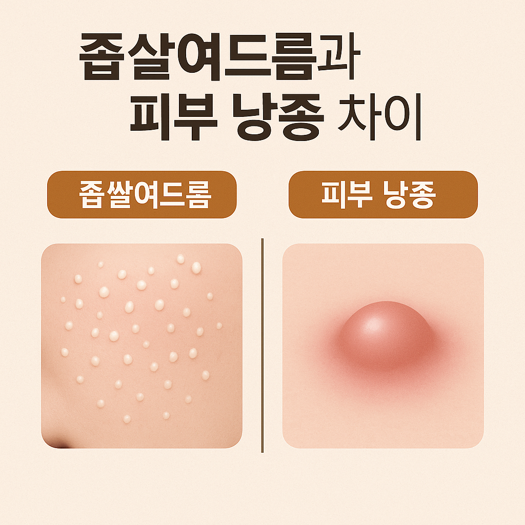좁쌀여드름과 피부 낭종 차이에 관란 썸네일