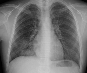 마이코플라즈마 폐렴
