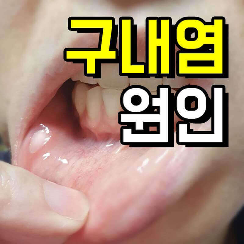 구내염으로 헐어버린 입 안쪽 점막