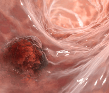 대장내시경 용종제거 후 식사 음주 주의사항 알아보기